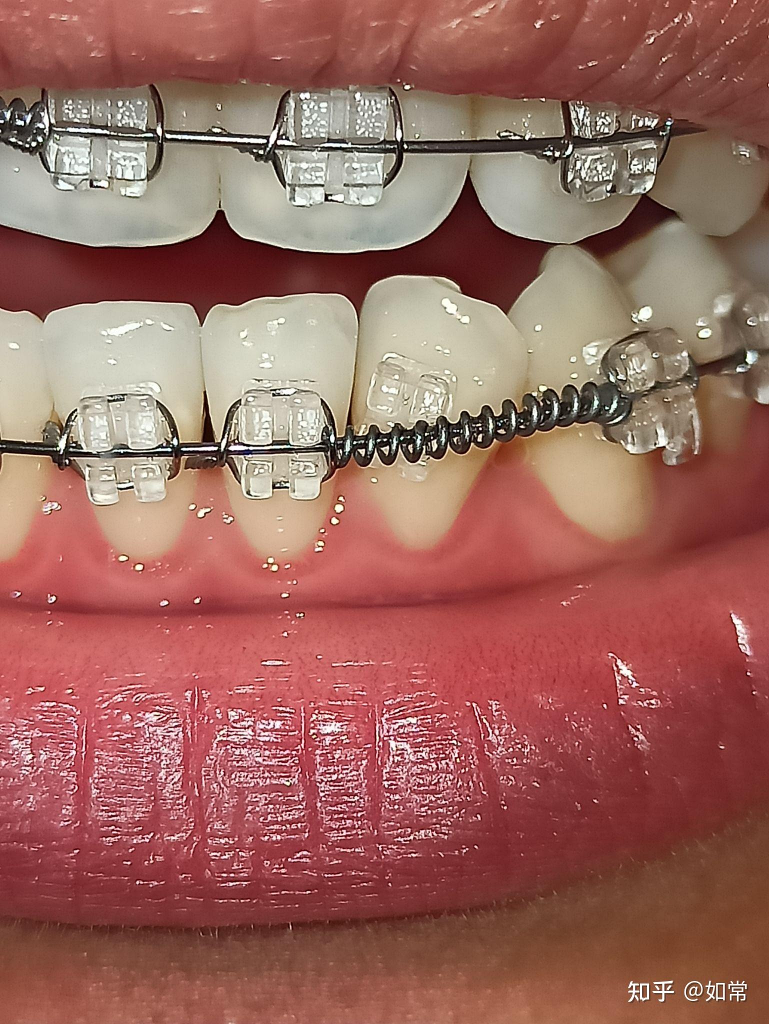 正畸日记已结束历时280天