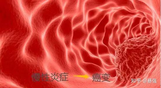 一 炎 不合就成癌 20 的癌症由炎症引发 这些身体预警不容忽视 知乎
