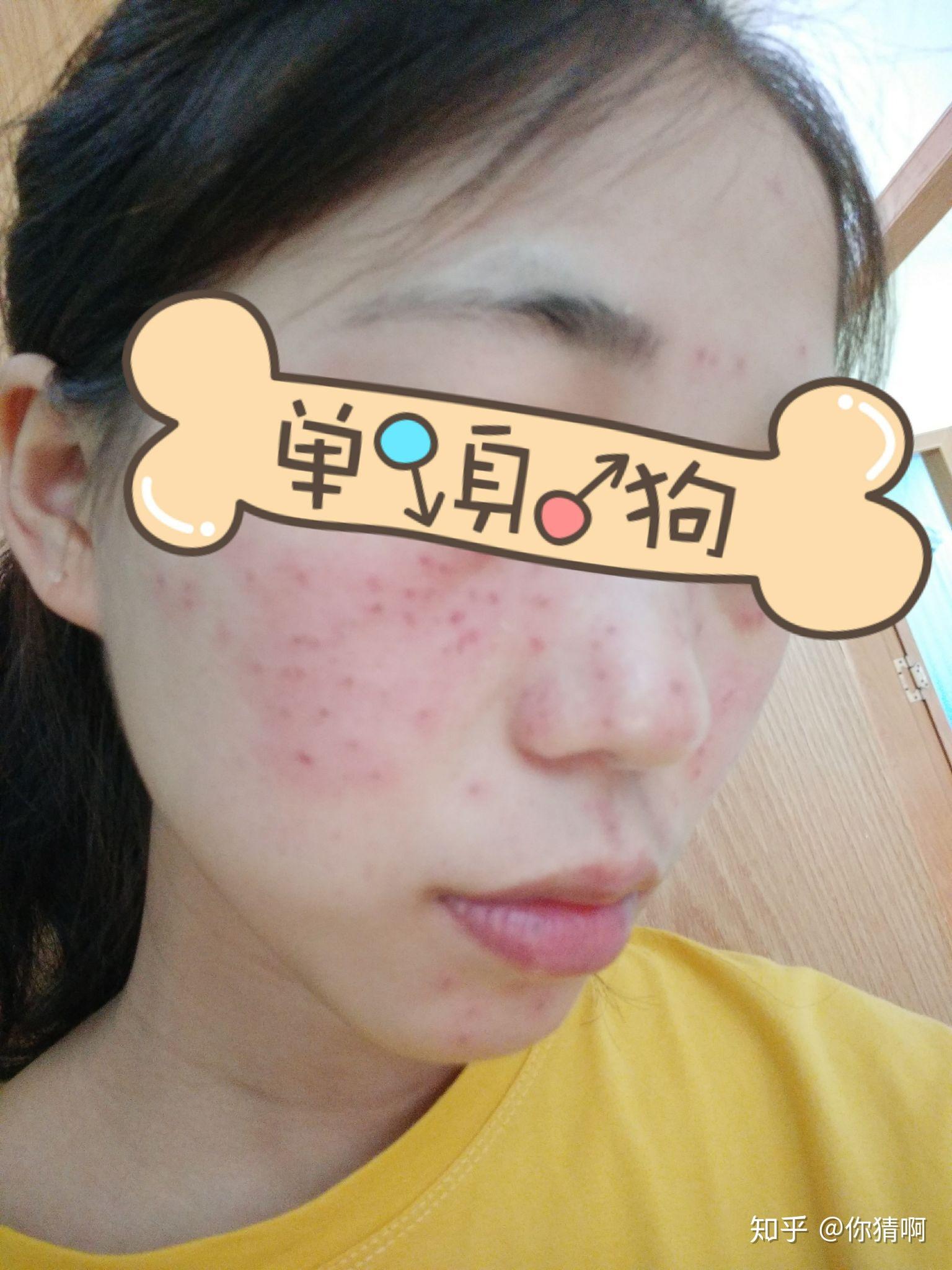 怎么去雀斑,激光祛斑怎么样?