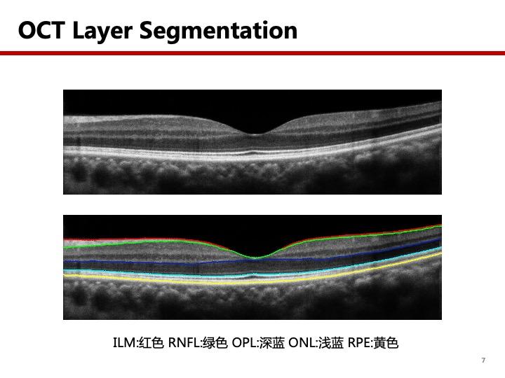 oct视网膜分层demo