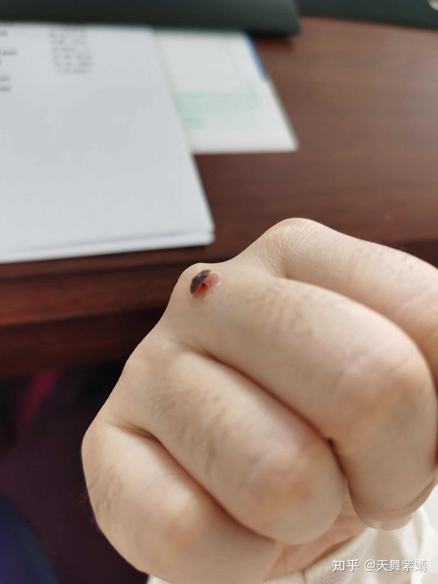 记录我的瘊子冷冻到脱落过程