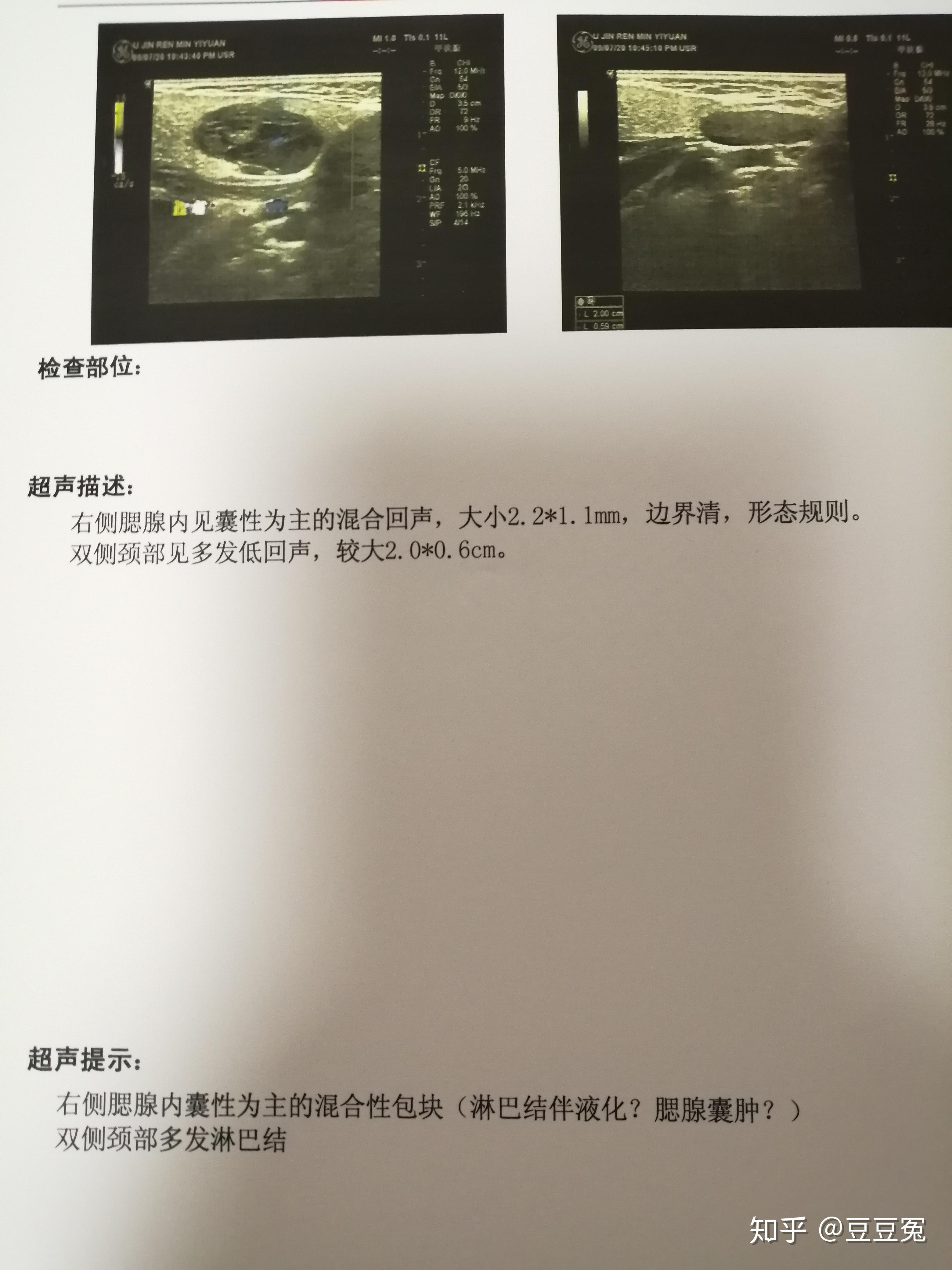 腮腺囊肿?见b超图?