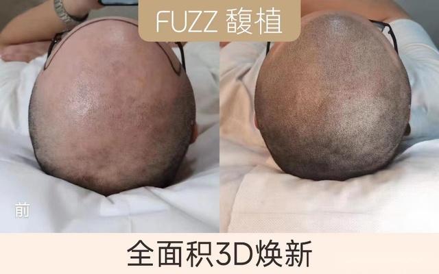 纹发效果是越黑越好吗？假发、植发、纹发该如何选择？ - 知乎
