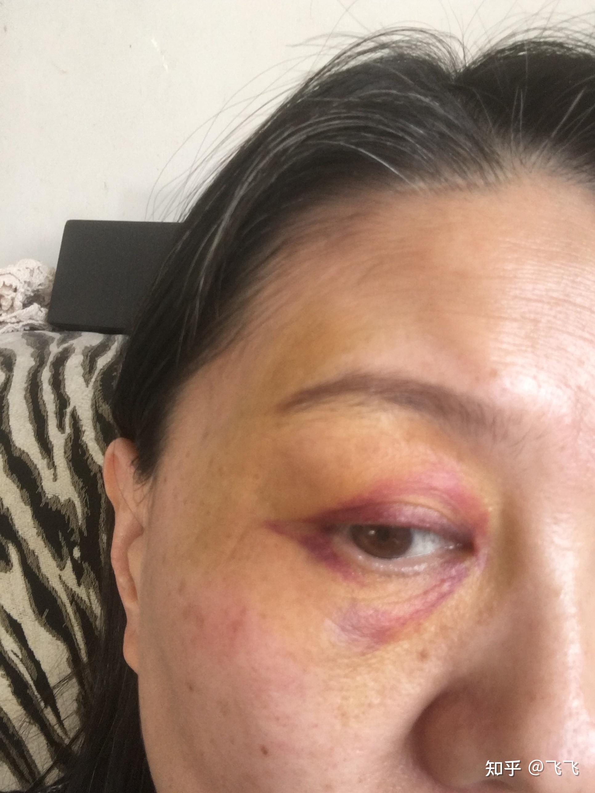 第七天淤青往下走了第八天眼皮上好很多第九天第十天基本好了,消肿