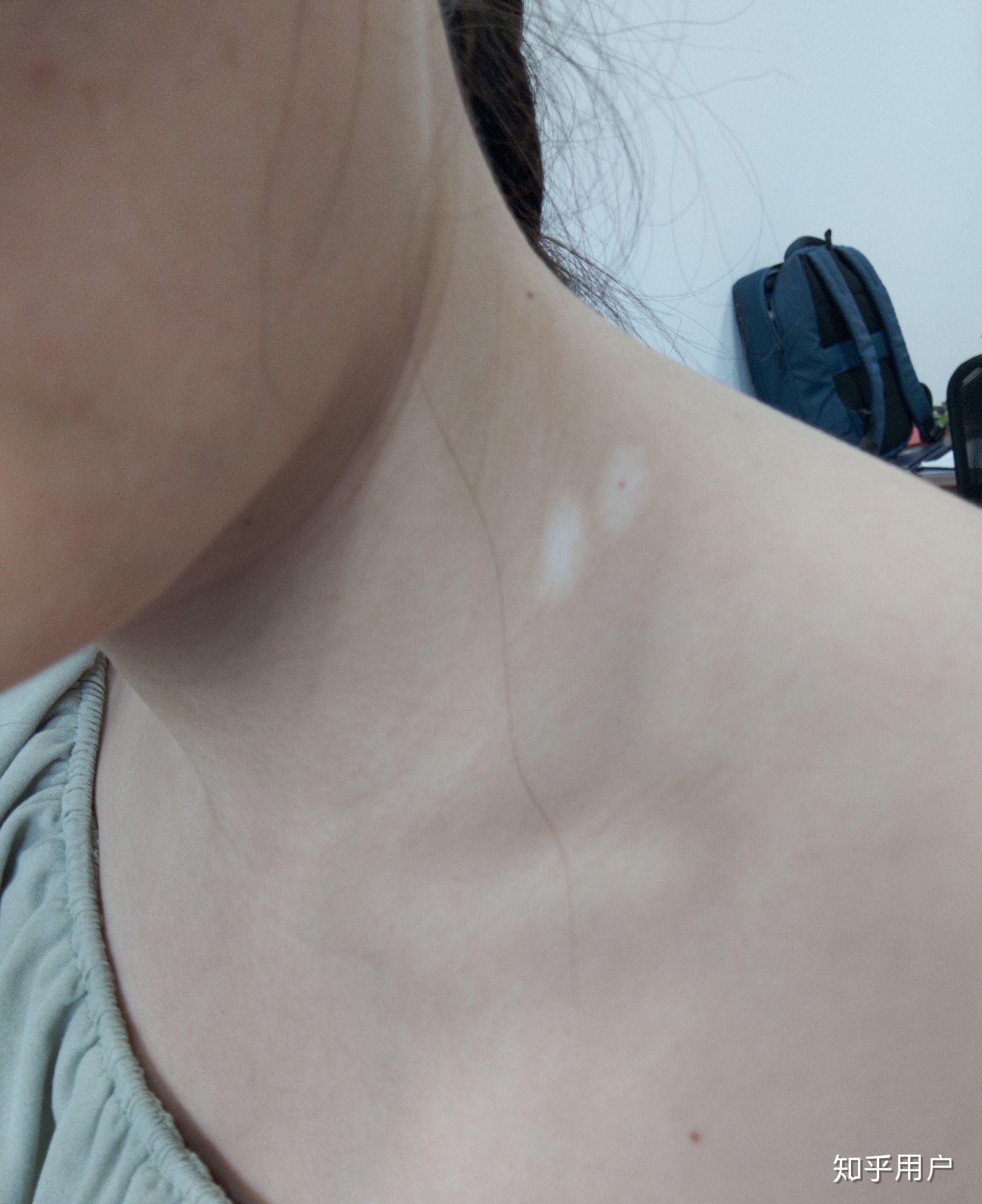 脸上有一角钱大小的晕痣有没有希望复原