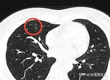 良性肺结节增大多考虑什么