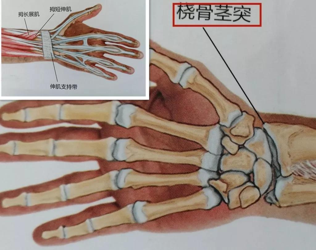 手腕酸痛、手指僵硬,你是腱鞘炎还是腕管综合征? _手指僵直 神拓网 手腕酸痛、手指僵硬,你是腱鞘炎还是腕管综合征? _手指僵直 神拓网