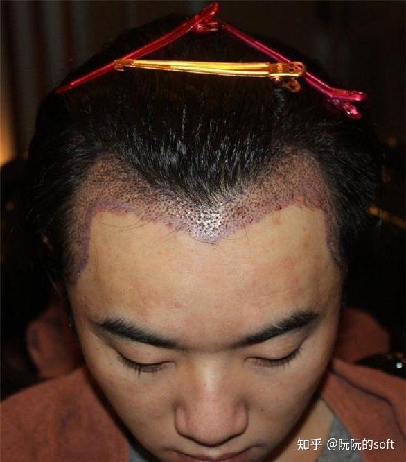 秃额角发际线高适合什么发型