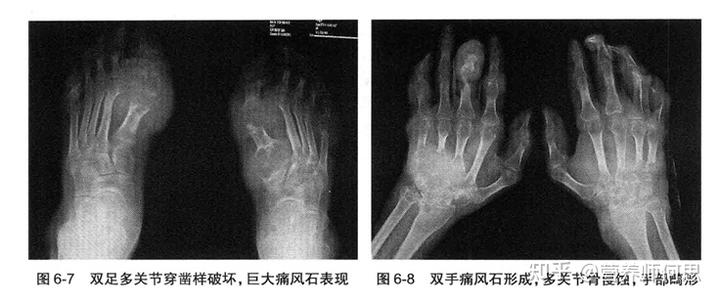 当代年轻人为什么会出现尿酸高? 6 v2 6aedaab9f0bdd15b816d0abe800f71ef 720w