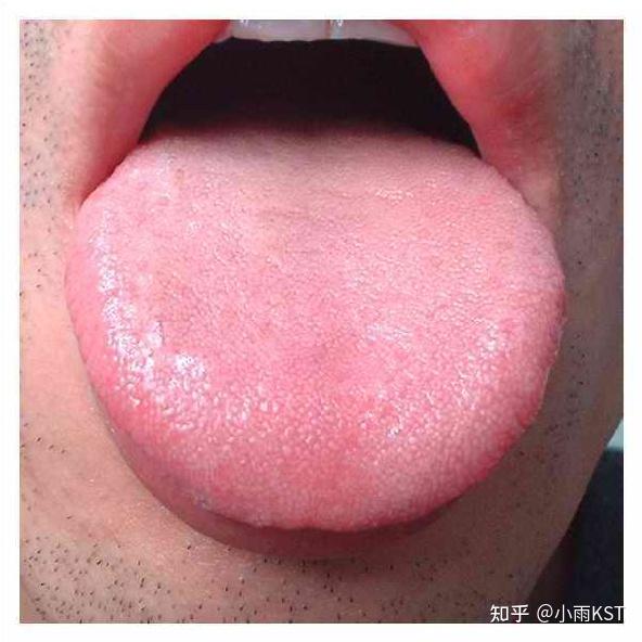 舌色,即舌质的颜色,一般分淡红,淡白,红,绛,青紫五大类,主要反映气血