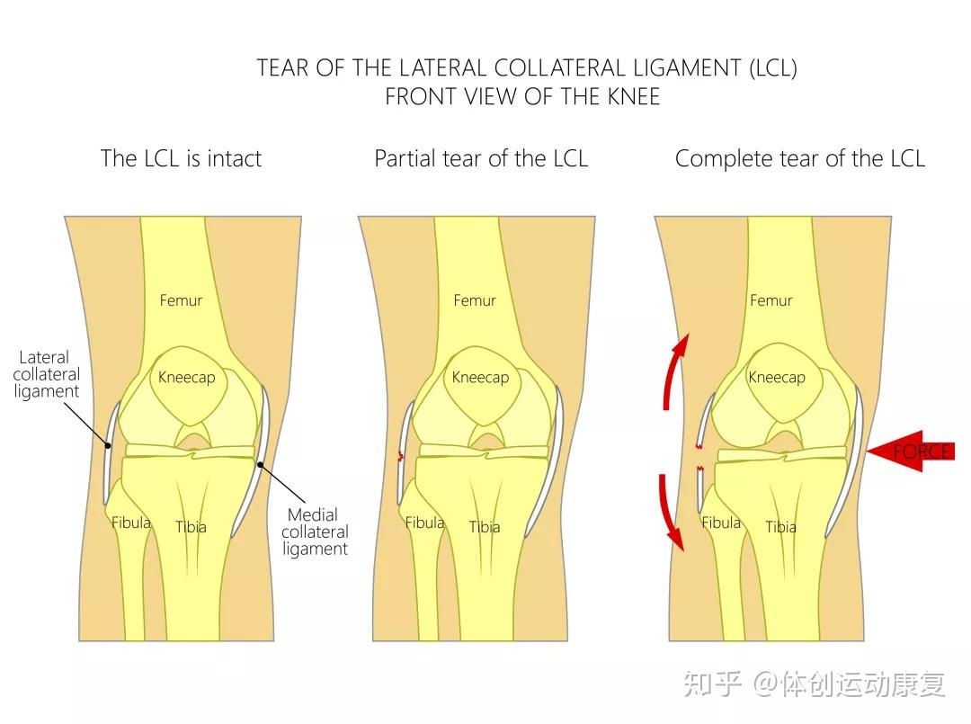 膝关节外侧副韧带解剖图片
