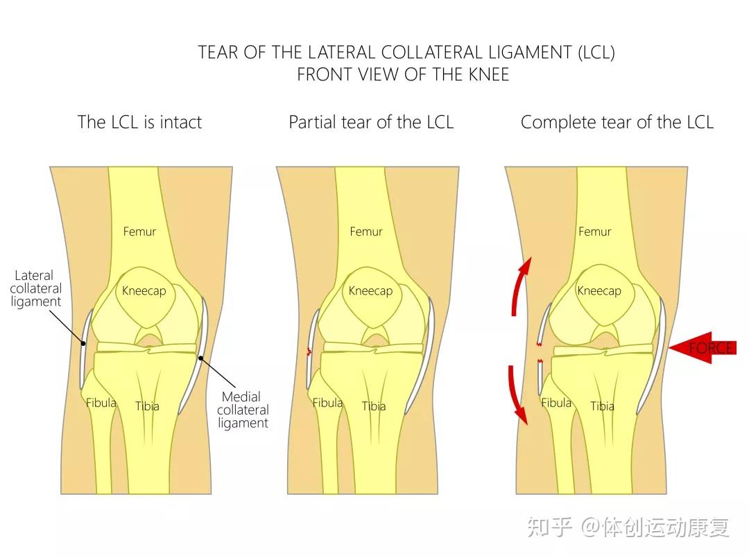 膝盖外侧疼,小心你的外侧副韧带撕裂!