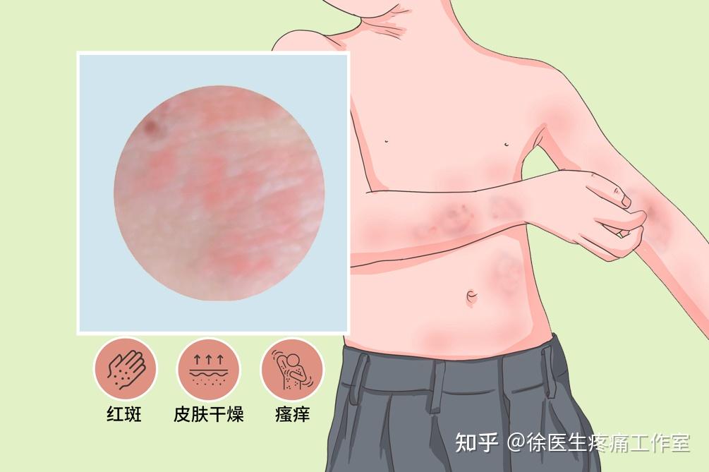 异位性皮肤炎不同年龄症状特征大不同!如何诊断