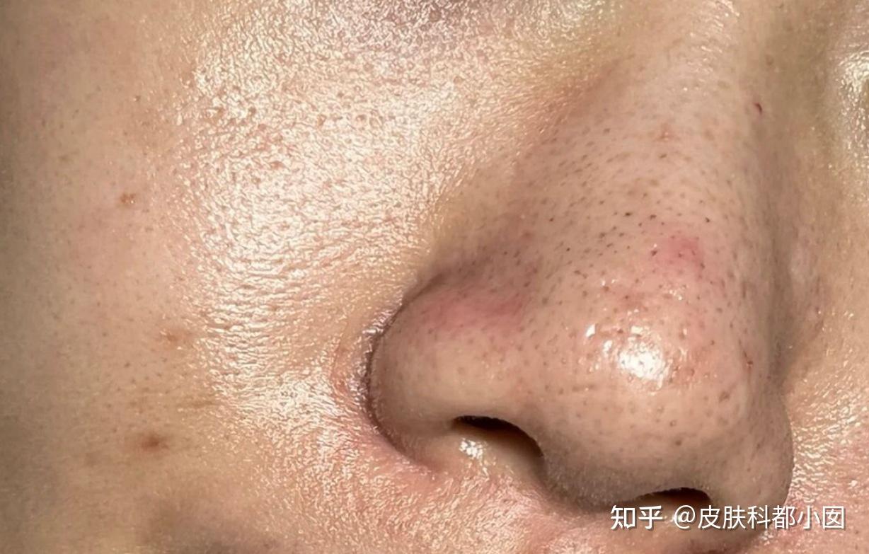 脸上的黑斑点是什么原因形成的？如何治疗？图_百度知道