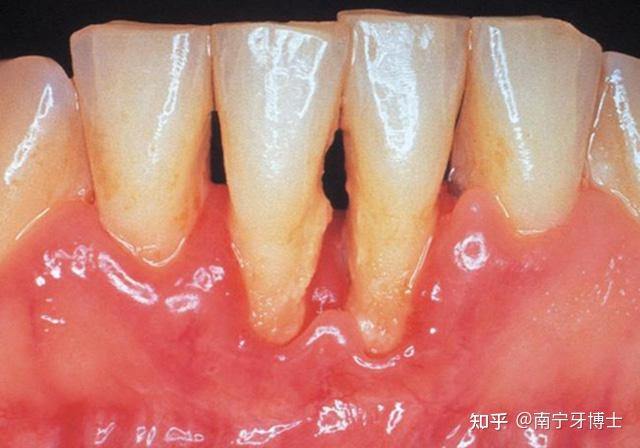 牙齿缝之间的黑三角是什么是怎么形成的