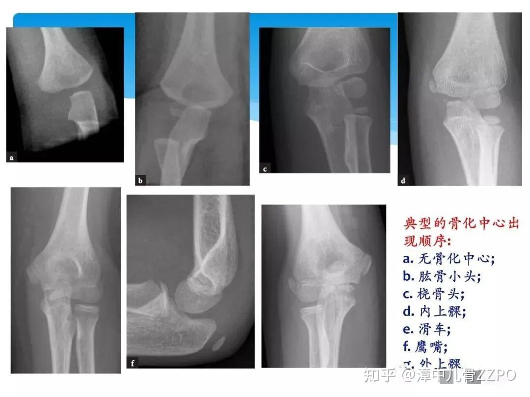 儿童肘关节x片正常图片