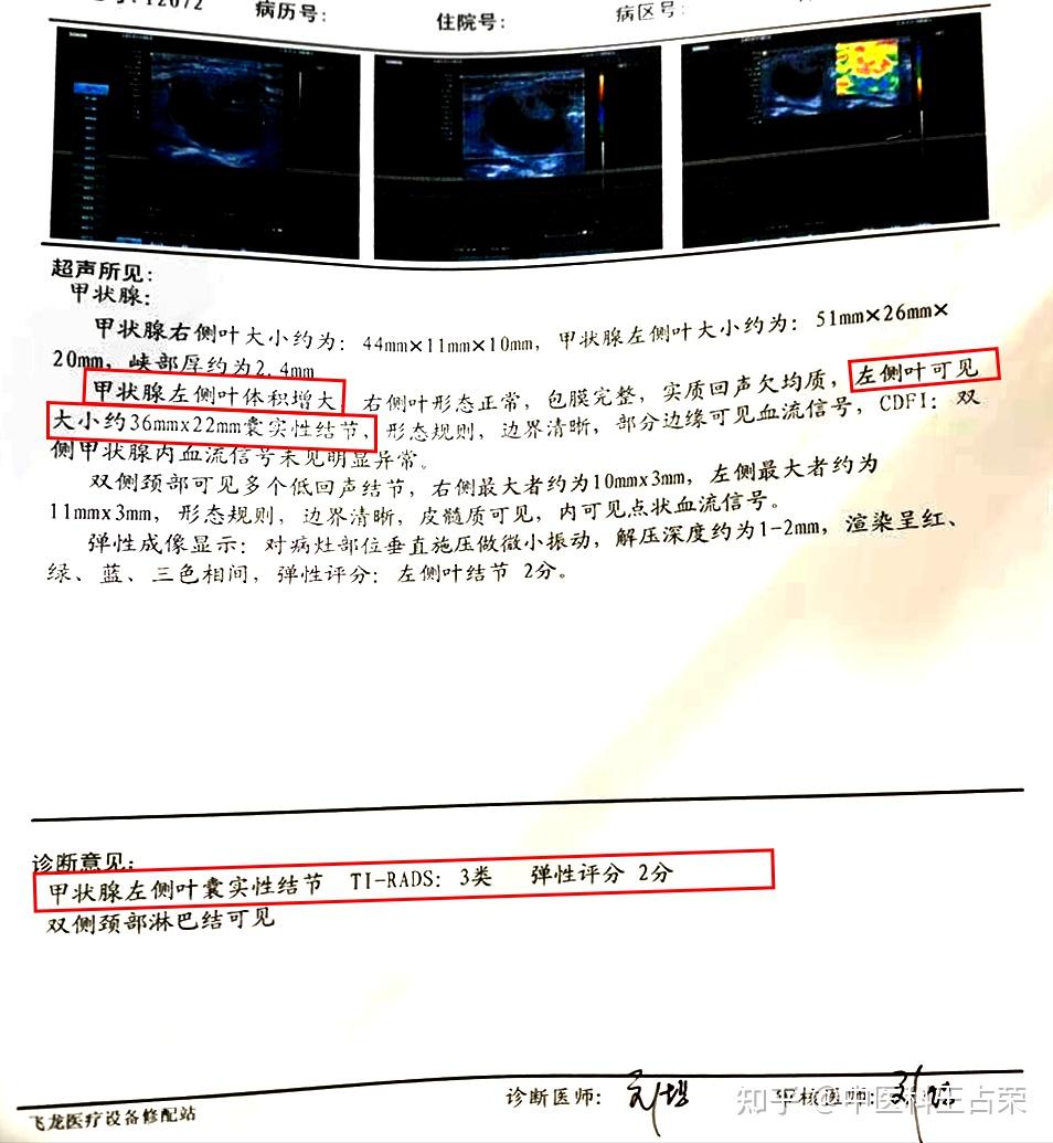 真實案例32歲女子精神壓力過大甲狀腺結節1年長到36cm中醫如何消腫