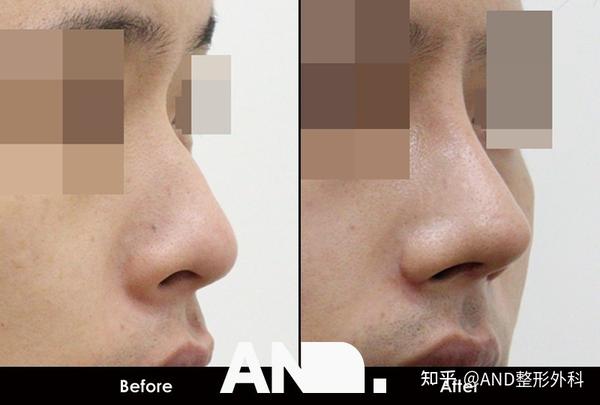 如果制定3D鼻部整形计划，会有多准确？ （模拟鼻部整形正确性）:鼻部整形[鼻梁+鼻尖+人中+鼻翼缩小+功能鼻]前后事例 - 知乎