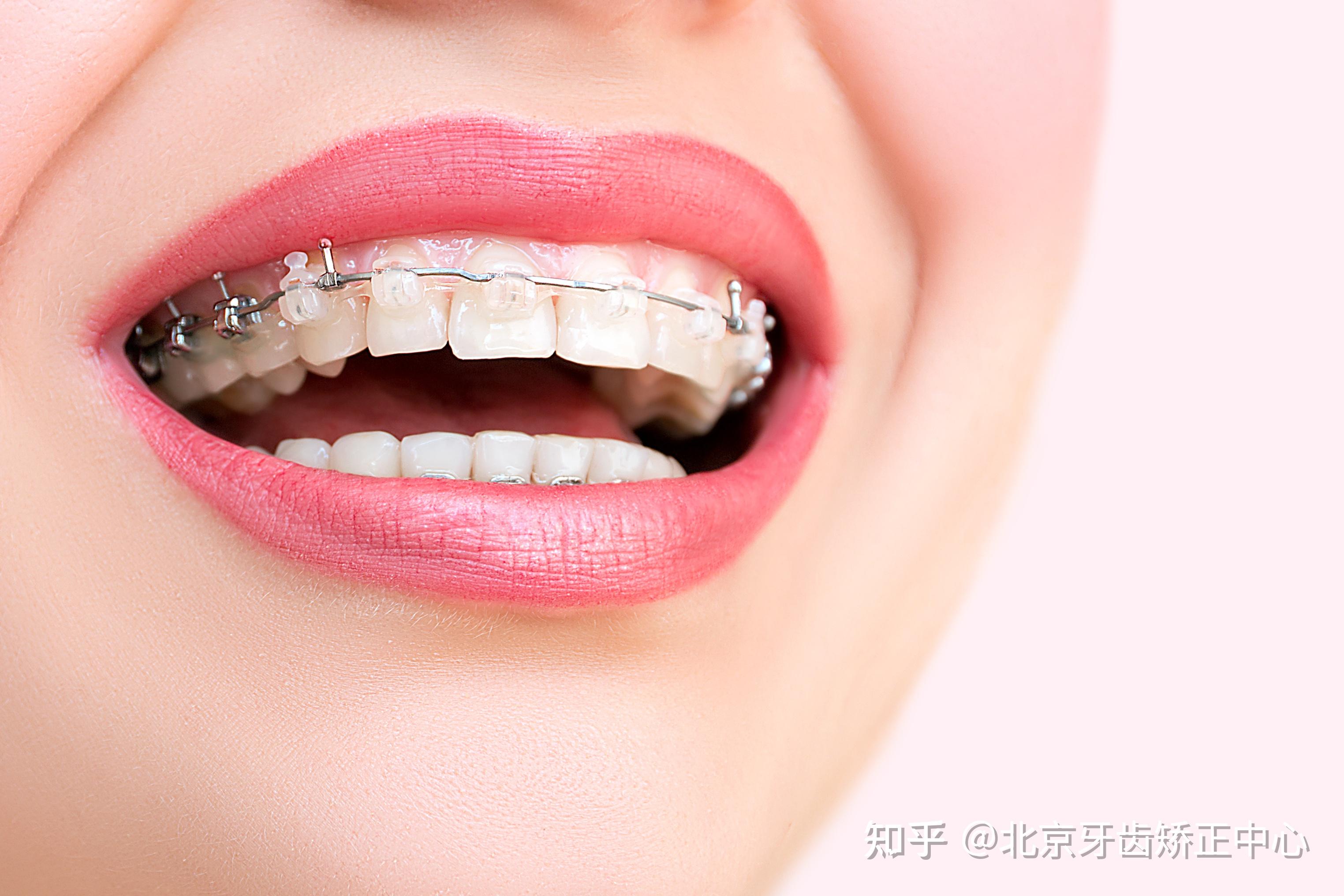是什么原因让你最终决定去做牙齿矫正? - 知乎