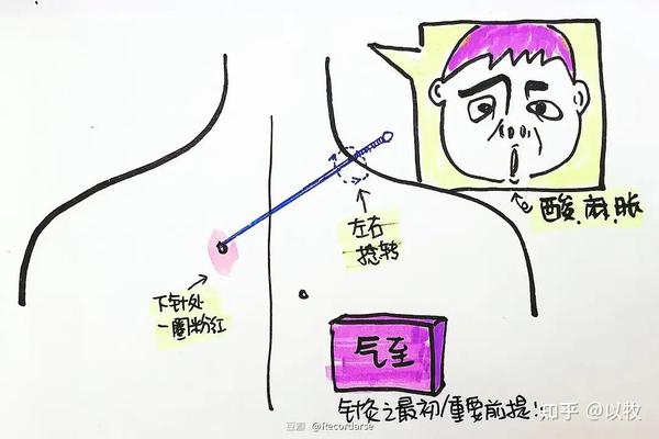 人纪针灸笔记(19)针刺法 - 知乎