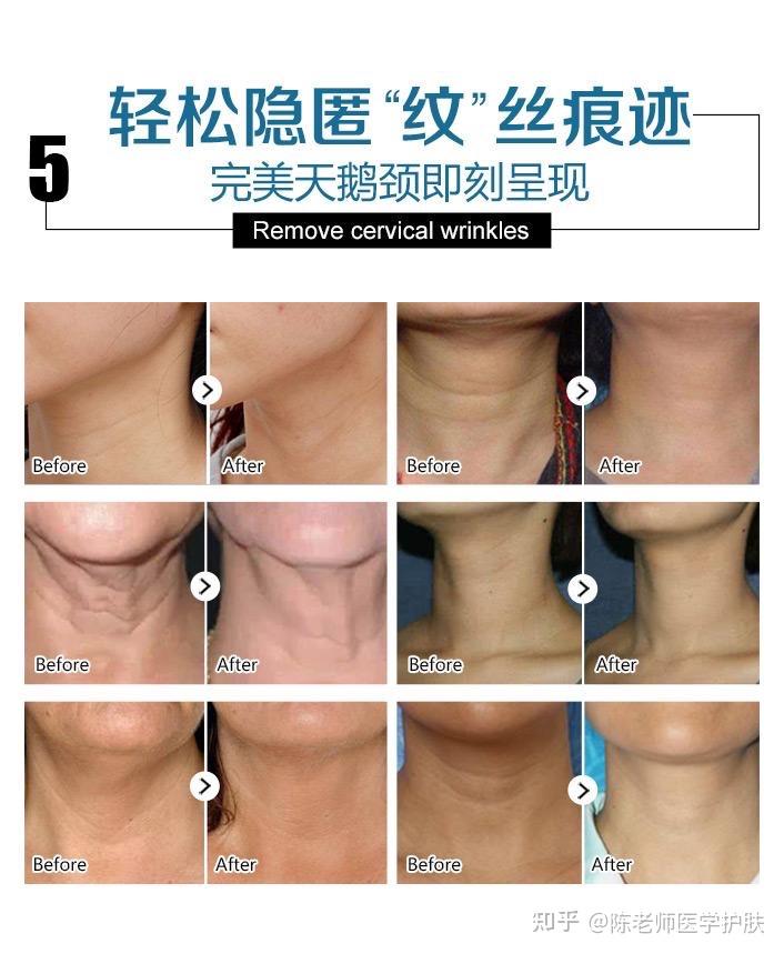 伊肤泉去除颈纹的单针微针结合治疗操作说明