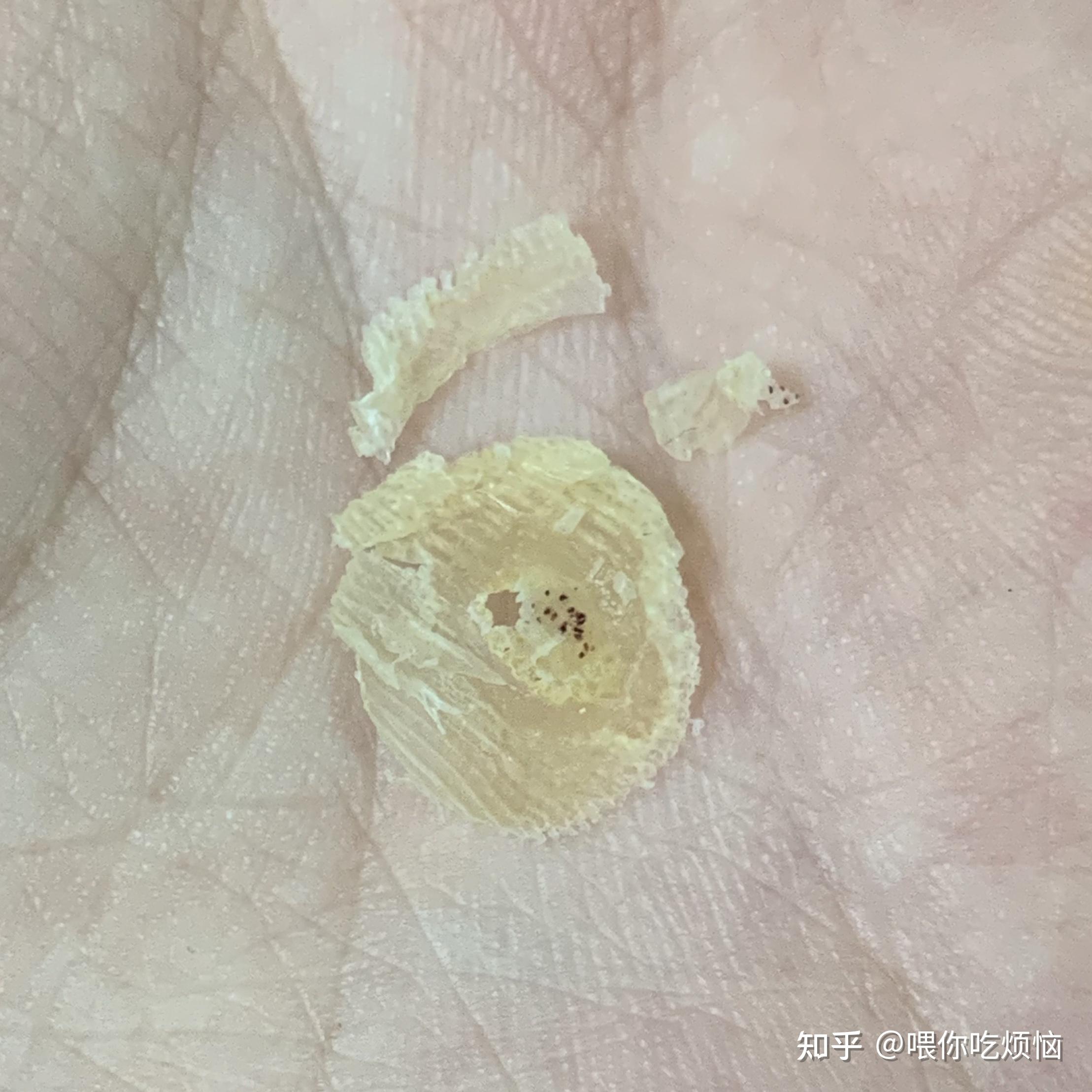 跖疣冷冻记录及康复过程(已康复) - 知乎