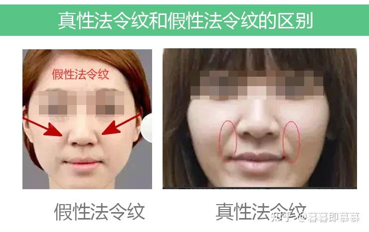 真性法令纹和假性法令纹的区别,淡化法令纹最好的方法(22条) - 知乎