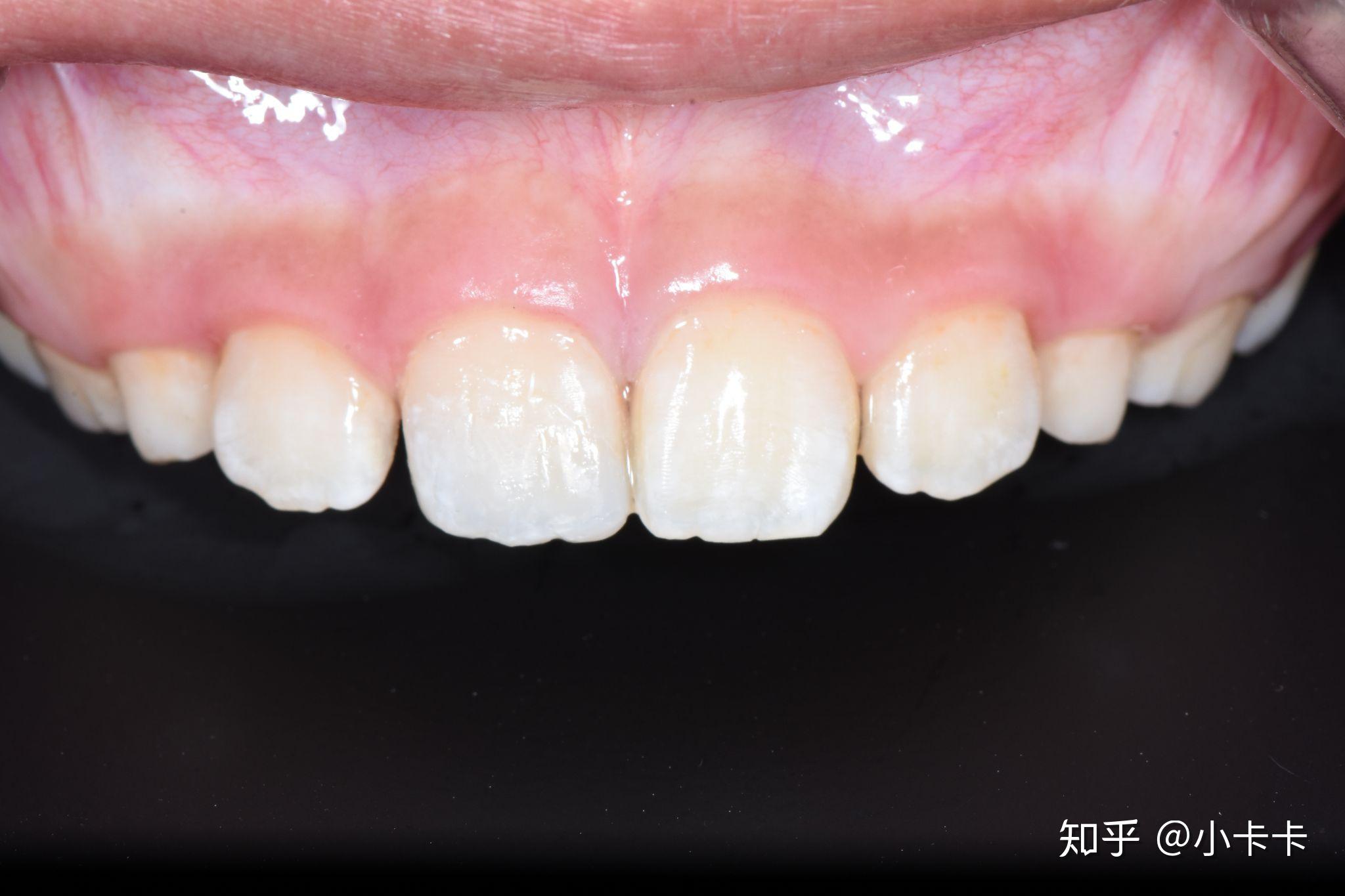 美国3M-NM树脂补牙（含全口拍片）-口腔服务-云看牙