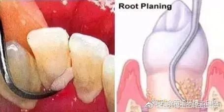 洗牙也分很多种 4种洗牙 4个等级 洗牙不被骗 知乎