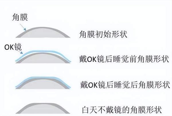 OK镜“集采”来袭，让人“每年花2万”的“眼科茅台”不再OK？ - 知乎