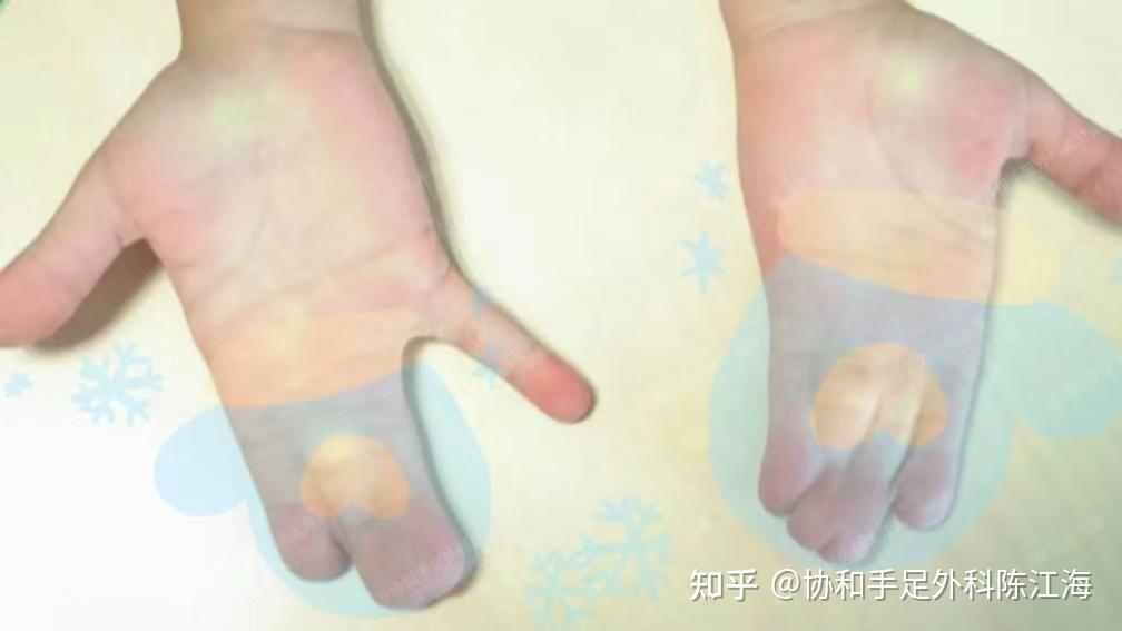 家族四代遗传手足并指,6岁宝宝该怎么办? - 知乎