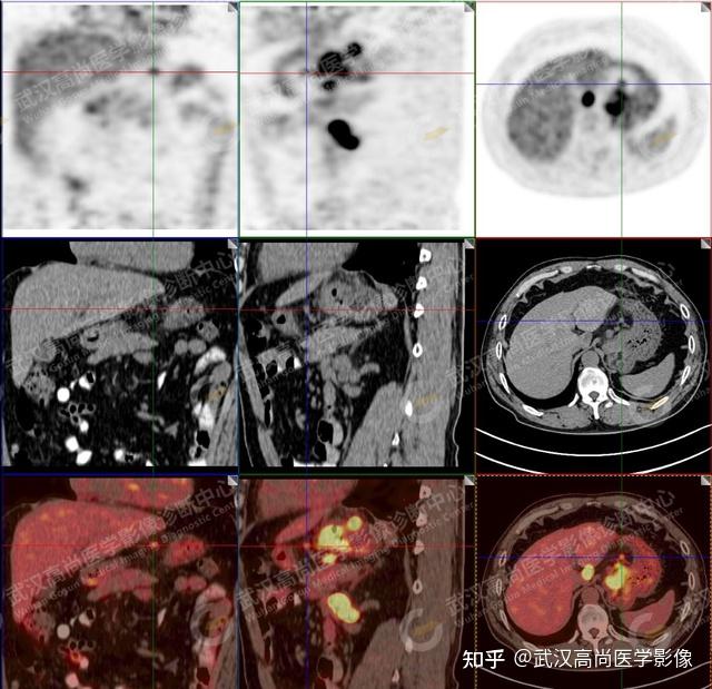 53岁患者吞咽哽咽感2月，PET-CT查出贲门癌「武汉高尚医学影像」 - 知乎