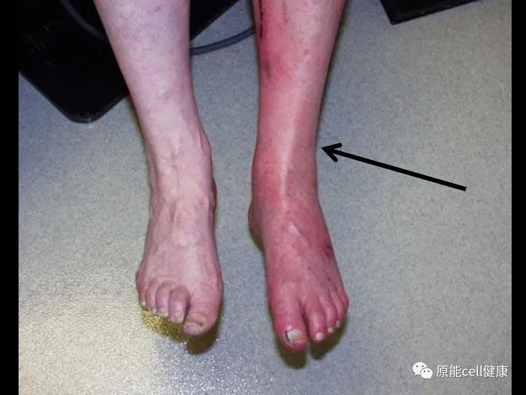 科普自体干细胞移植治疗下肢慢性缺血