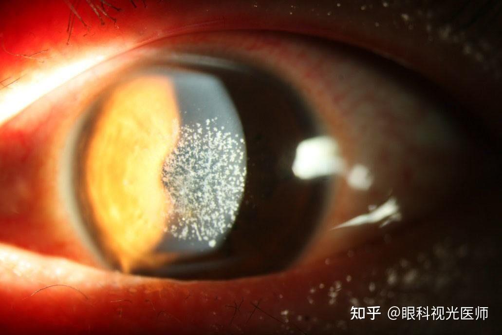 角膜的疾病