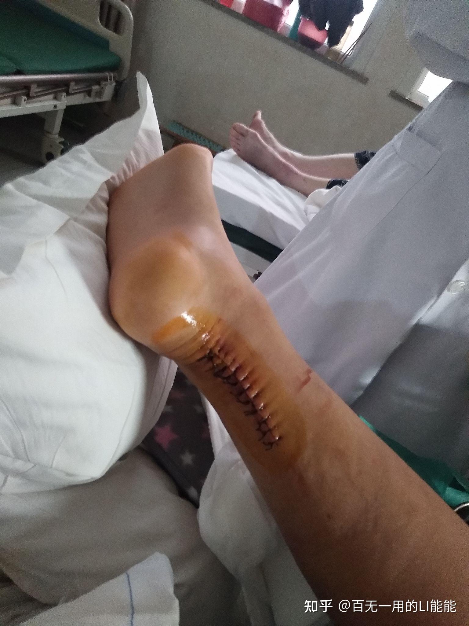 断友日记二十岁跟腱断裂患者康复私信我共享你康复计划