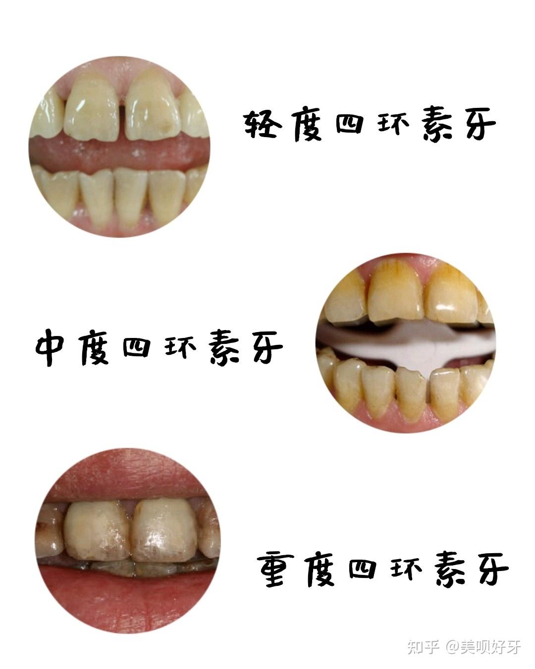 牙齿美白都有什么方法做牙齿美白价格贵吗美白方法该如何选择