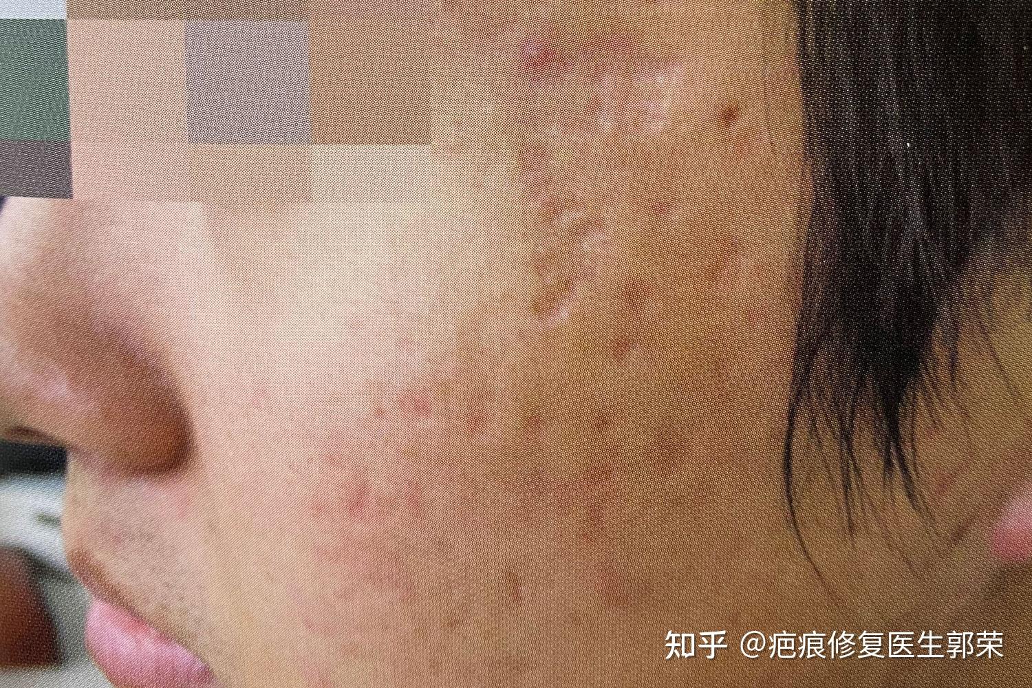 脸部凹陷型疤痕怎么治疗呢