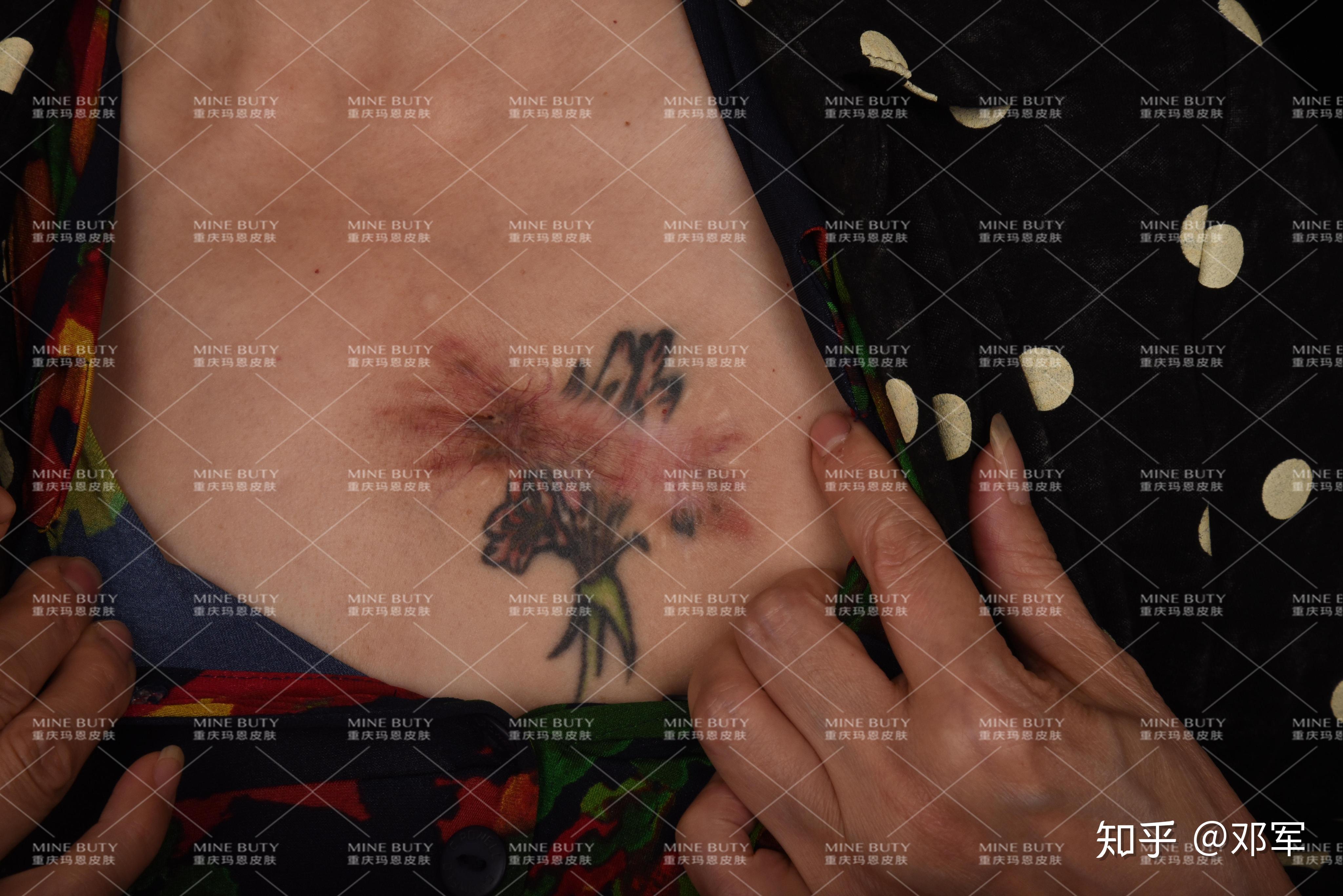 综上:在纹身瘢痕疙瘩治疗中,一定要配合抗瘢痕增生综合治疗,否则复发