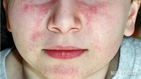 秋天,请警惕光损伤性皮肤病 - 知乎