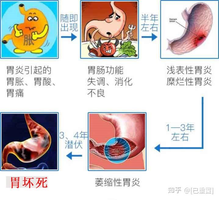 刘氏五部一个好方轻松解决慢性胃炎萎缩性胃炎