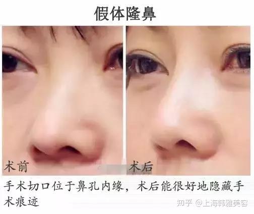 整形手术的切口都“藏在哪”? - 知乎