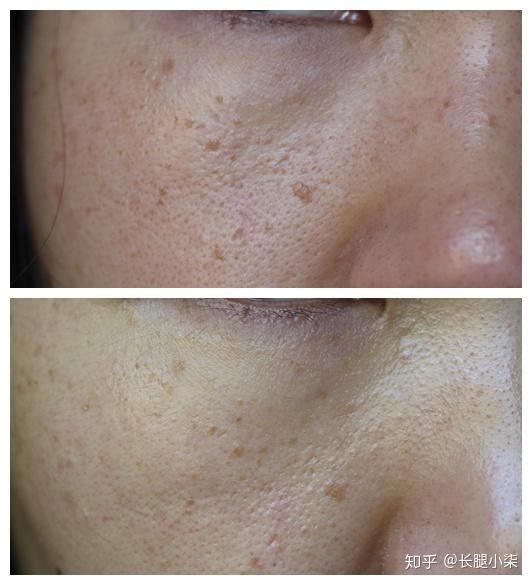 扁平疣记录 - 知乎