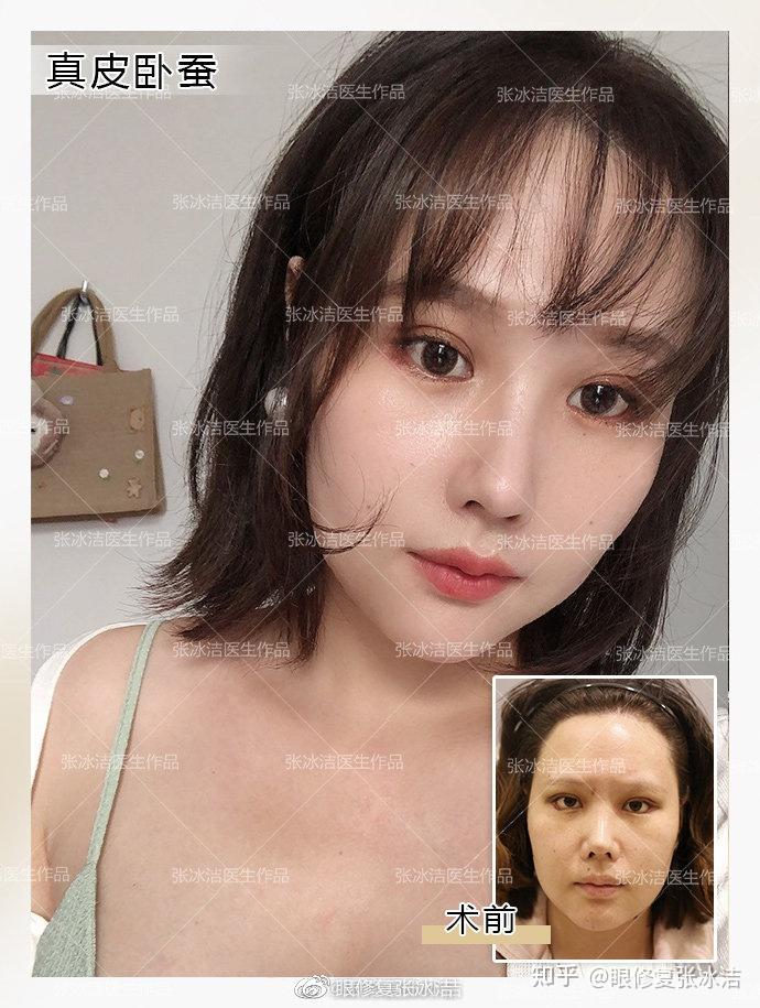 张冰洁谈自体真皮卧蚕丨卧蚕与眼袋有何区别自体真皮卧蚕的优势2