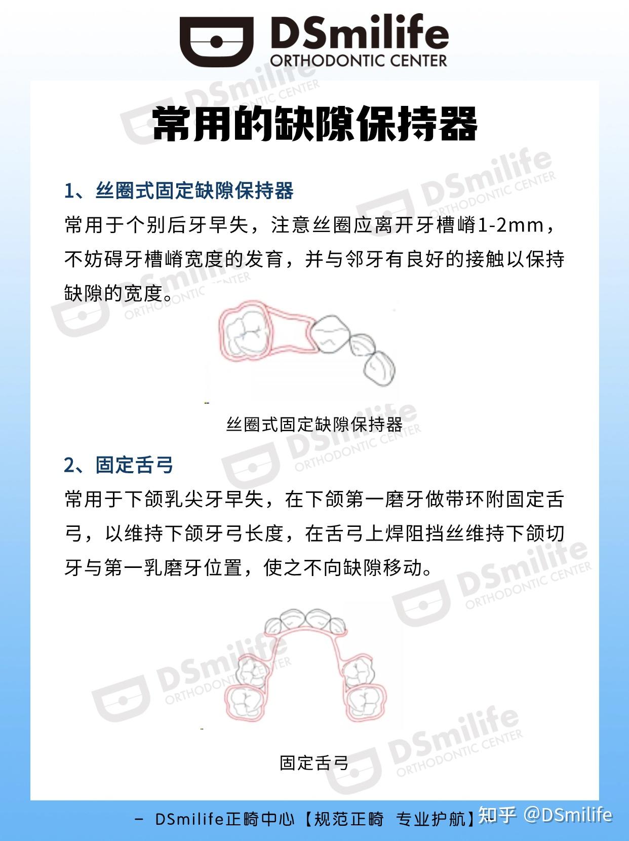 ds正畸培训|常用的缺隙保持器