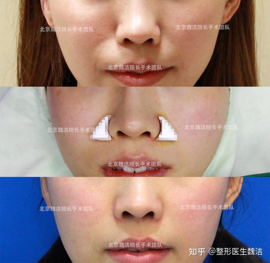医生关于假体垫鼻翼基底是否移位的客观表述 鼻基底术前必看