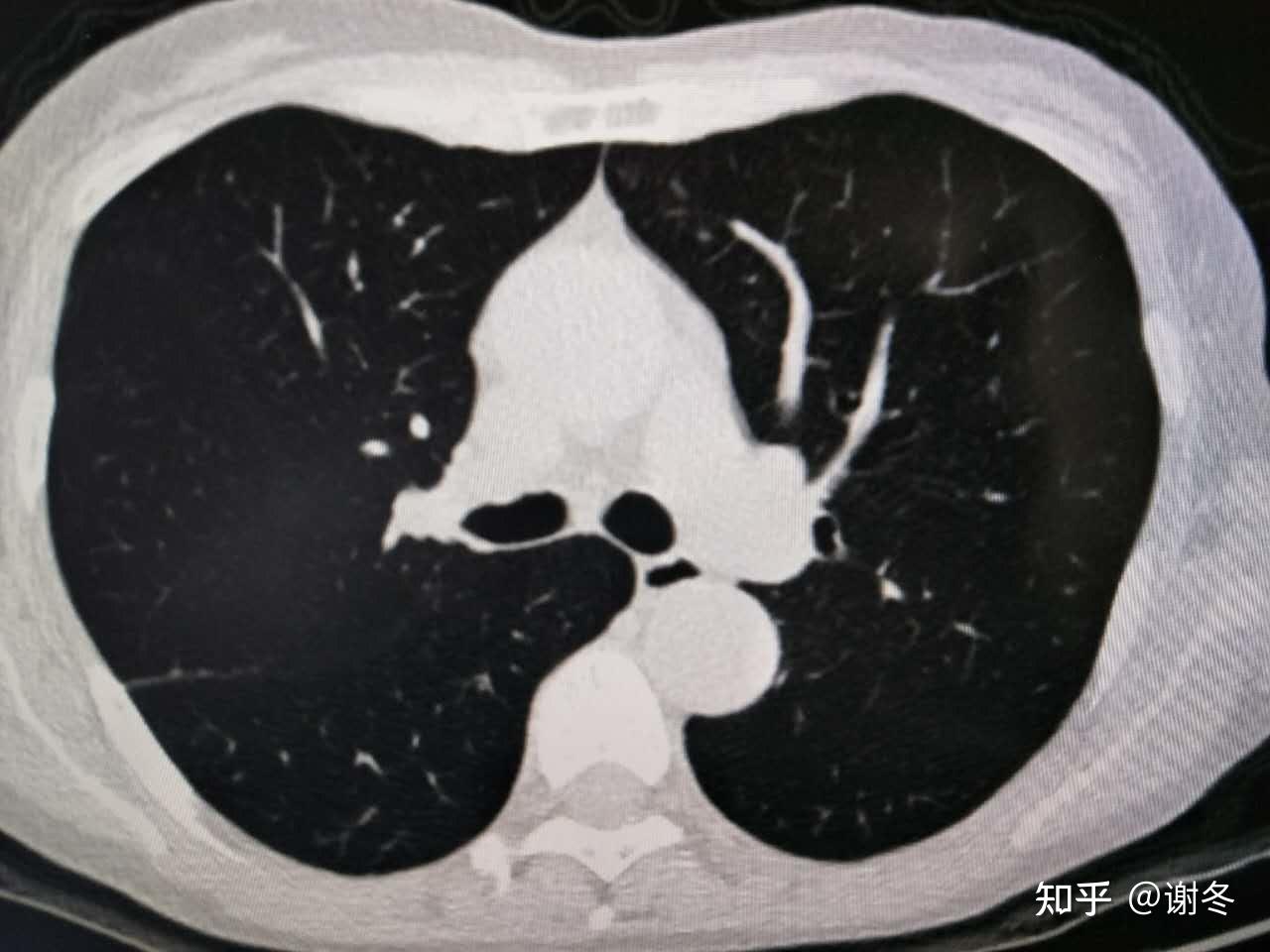 肺磨玻璃結節會消失嗎為什麼磨玻璃結節要重視隨訪