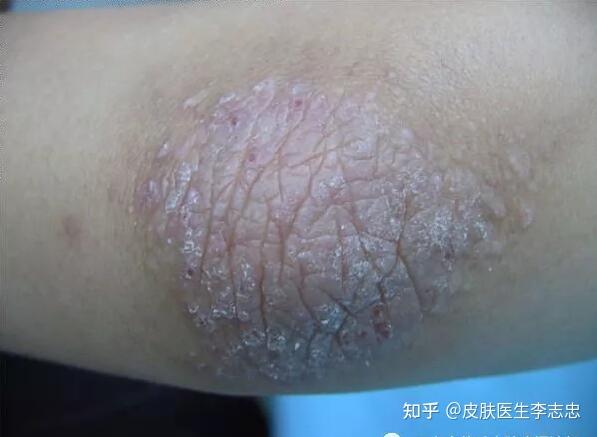 中医治疗神经性皮炎 - 知乎