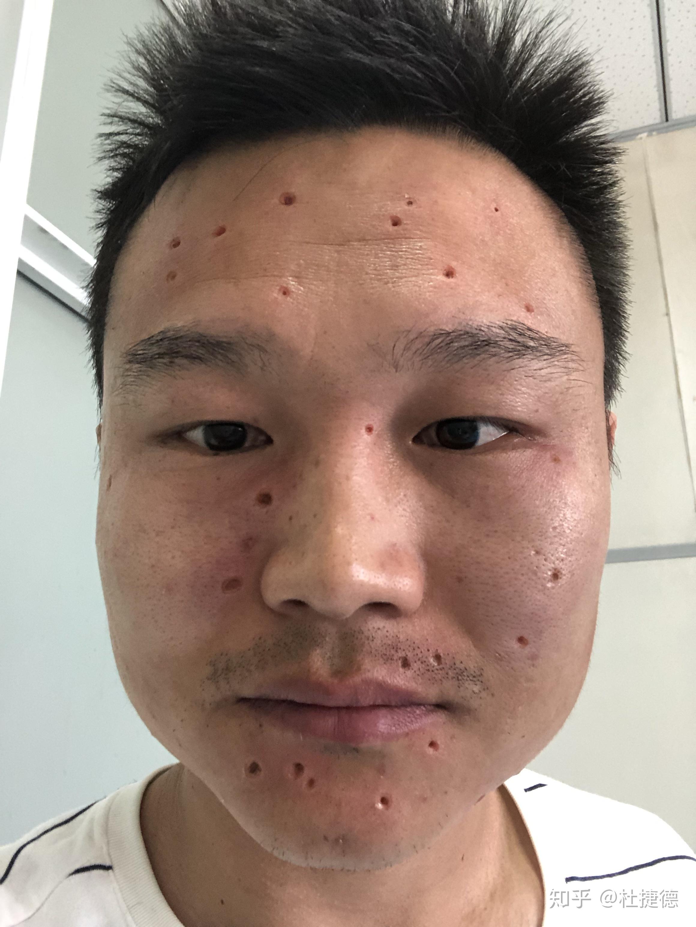 祛痣我犹豫了好几年