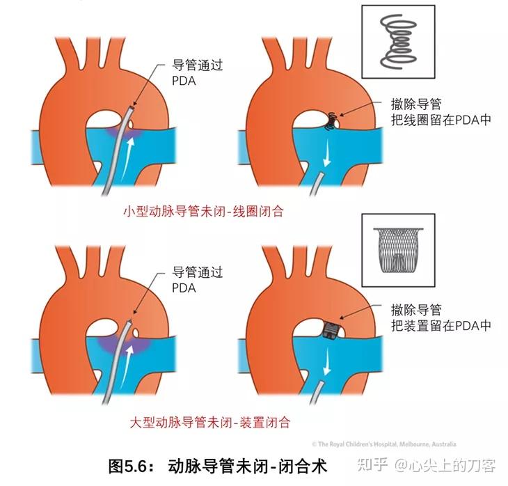 动脉导管未闭超声ppt图片