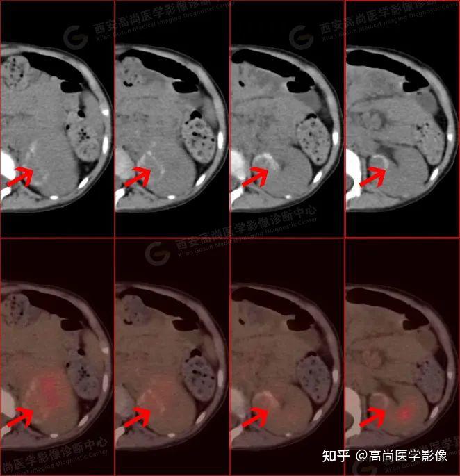 18F-FDG PETCT诊断肾上腺神经母细胞瘤一例【高尚医学影像】 - 知乎